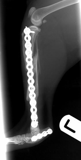 radiographic union of both fractures